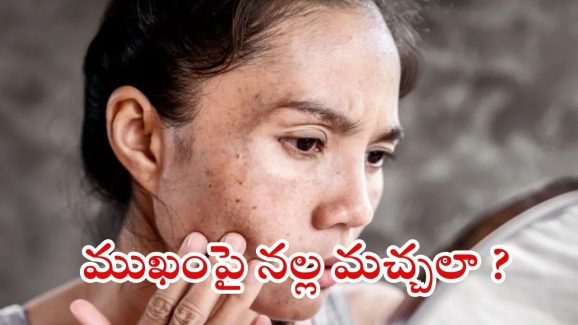 Dark Spots: ముఖంపై నల్ల మచ్చలా ? ఇలా చేస్తే.. ప్రాబ్లమ్ సాల్వ్