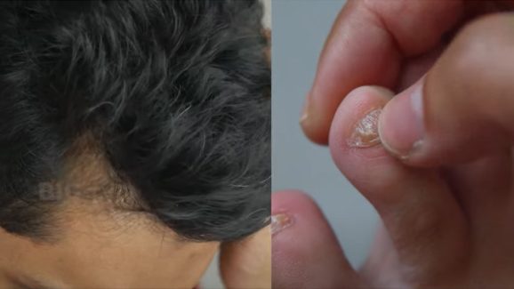 Hair loss in Buldhana: పల్లెల్లో వింత వ్యాధులు..! అసలు కారణం ఇదే..