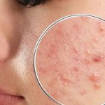 Pimples: ముఖంపై మొటిమలు.. ఏం చెబుతున్నాయో తెలుసుకుందామా ?
