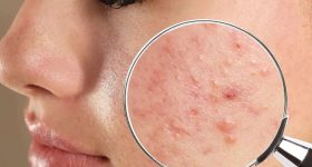 Pimples: ముఖంపై మొటిమలు.. ఏం చెబుతున్నాయో తెలుసుకుందామా ?