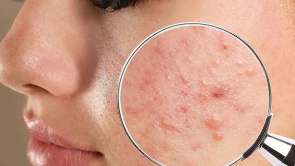 Pimples: ముఖంపై మొటిమలు.. ఏం చెబుతున్నాయో తెలుసుకుందామా ?
