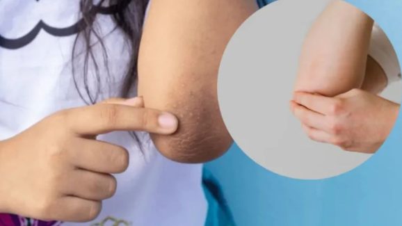 Dark Elbows: మోచేతులు నల్లగా మారాయా ? ఇలా చేస్తే.. క్షణాల్లోనే మెరిసిపోతాయ్