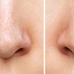 Blackheads: బ్లాక్ హెడ్స్ తగ్గించే బెస్ట్ టిప్స్ ఇవే.. ట్రై చేస్తే మంచి రిజల్ట్