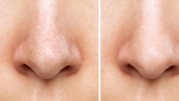 Blackheads: బ్లాక్ హెడ్స్ తగ్గించే బెస్ట్ టిప్స్ ఇవే.. ట్రై చేస్తే మంచి రిజల్ట్
