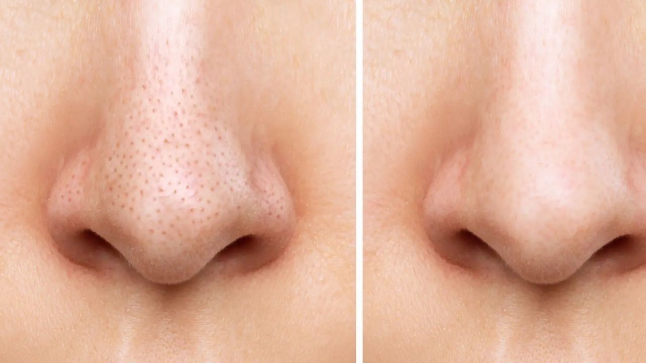 Blackheads: బ్లాక్ హెడ్స్ తగ్గించే బెస్ట్ టిప్స్ ఇవే.. ట్రై చేస్తే మంచి రిజల్ట్