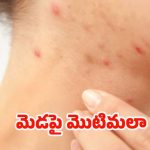 Pimples On Neck: మెడపై మొటిమలా ? వీటిని వాడితే.. సమస్య దూరం