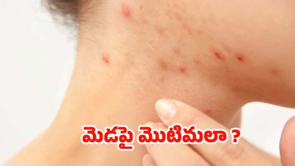Pimples On Neck: మెడపై మొటిమలా ? వీటిని వాడితే.. సమస్య దూరం