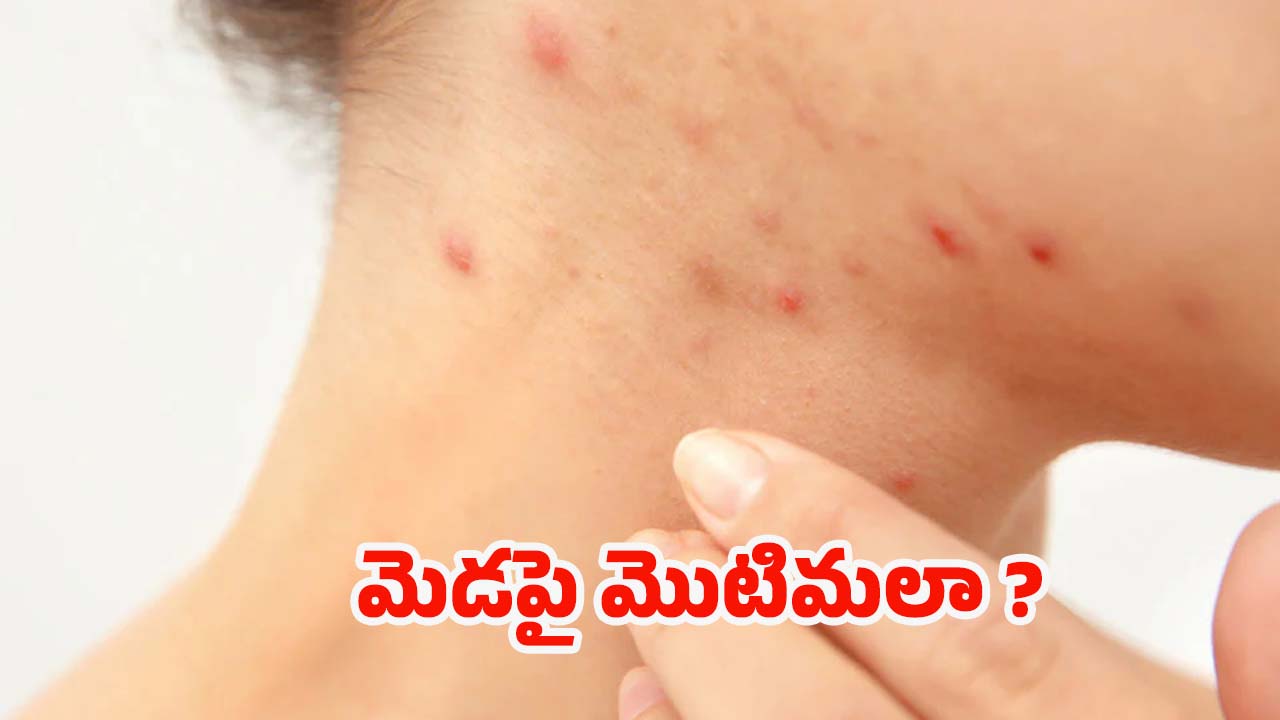 Pimples On Neck: మెడపై మొటిమలా ? వీటిని వాడితే.. సమస్య దూరం