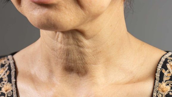 Wrinkles On Neck: ముడతలు లేకుండా యవ్వనంగా కనిపించాలంటే.. ఇలా చేయండి !