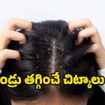 Home Remedies For Dandruff: చుండ్రుతో ఇబ్బంది పడుతున్నారా? ఈ 5 హోం రెమెడీస్‌తో ప్రాబ్లమ్ సాల్వ్