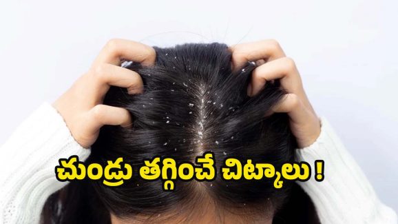 Home Remedies For Dandruff: చుండ్రుతో ఇబ్బంది పడుతున్నారా? ఈ 5 హోం రెమెడీస్‌తో ప్రాబ్లమ్ సాల్వ్