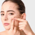 Face Acne Reasons: ముఖంపై మొటిమలా ? కారణాలేంటో తెలుసుకోండి !