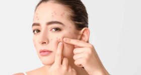 Face Acne Reasons: ముఖంపై మొటిమలా ? కారణాలేంటో తెలుసుకోండి !