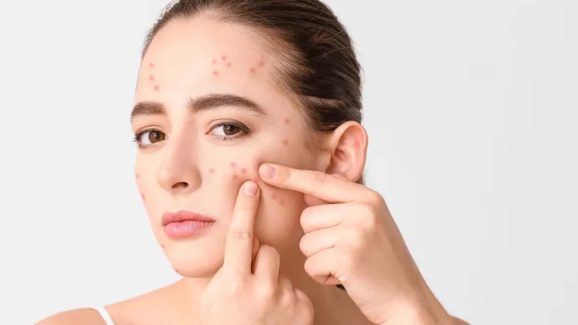 Face Acne Reasons: ముఖంపై మొటిమలా ? కారణాలేంటో తెలుసుకోండి !