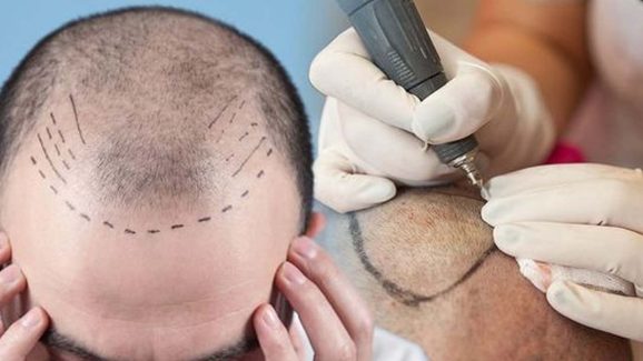 Hair Transplant: హెయిర్ ట్రాన్స్ప్లాంటేషన్‌తో ప్రాణాలకే ప్రమాదం.. పరిశోధనల్లో షాకింగ్ నిజాలు
