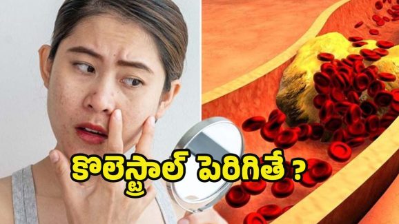 High Cholesterol: మహిళల శరీరంలో కొలెస్ట్రాల్ పెరిగినప్పుడు.. కనిపించే లక్షణాలివే !