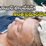 Kanpur Horror: బట్టతలపై వెంట్రుకలు.. ఇద్దరి ప్రాణం తీసిన హెయిర్ ట్రాన్స్ ప్లాంట్!