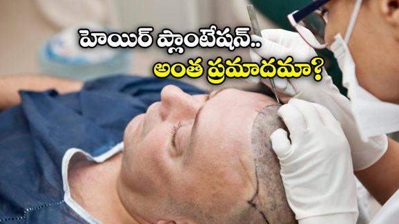 Kanpur Horror: బట్టతలపై వెంట్రుకలు.. ఇద్దరి ప్రాణం తీసిన హెయిర్ ట్రాన్స్ ప్లాంట్!