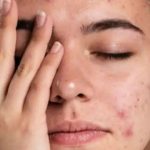 Tips For Black Spots: ఈ హోం రెమెడీస్ వాడితే.. ముఖం మీద మచ్చలు మాయం !
