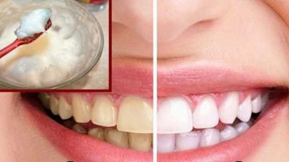 Tips For White Teeth: ఉప్పులో ఈ ఒక్కటి కలిపి వాడితే.. పళ్లు తెల్లగా మెరుస్తాయ్