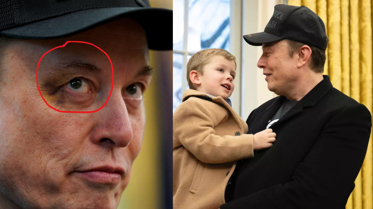 Elon Musk: కొడుకుతో తన్నులు తిన్న మస్క్ మామ.. పాపం కన్ను చూశారా ఎలా అయిపోయిందో!