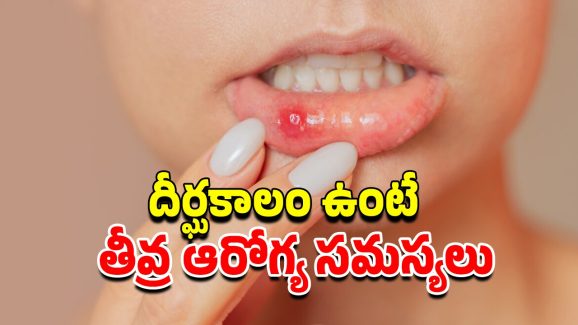 Mouth Ulcers Causes: నోటి పూతలు ఎందుకు వస్తాయి?.. నివారణకు ఈ జాగ్రత్తలు పాటించండి