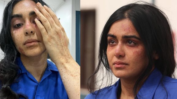 Adah Sharma: అలాంటి సమస్యతో బాధపడుతున్న అదాశర్మ.. మొత్తం కందిబారిపోయి..!
