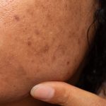 Pigmentation: పిగ్మెంటేషన్ సమస్యకు కీరతో చెక్ పెట్టొచ్చని తెలుసా?