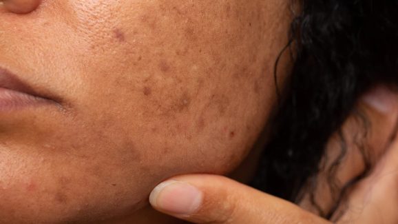 Pigmentation: పిగ్మెంటేషన్ సమస్యకు కీరతో చెక్ పెట్టొచ్చని తెలుసా?