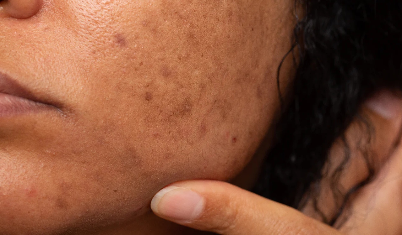 Pigmentation: పిగ్మెంటేషన్ సమస్యకు కీరతో చెక్ పెట్టొచ్చని తెలుసా?