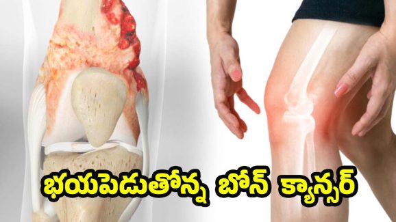 Bone Cancer Symptoms: బోన్ క్యాన్సర్.. ప్రారంభంలో కనిపించే లక్షణాలివే !