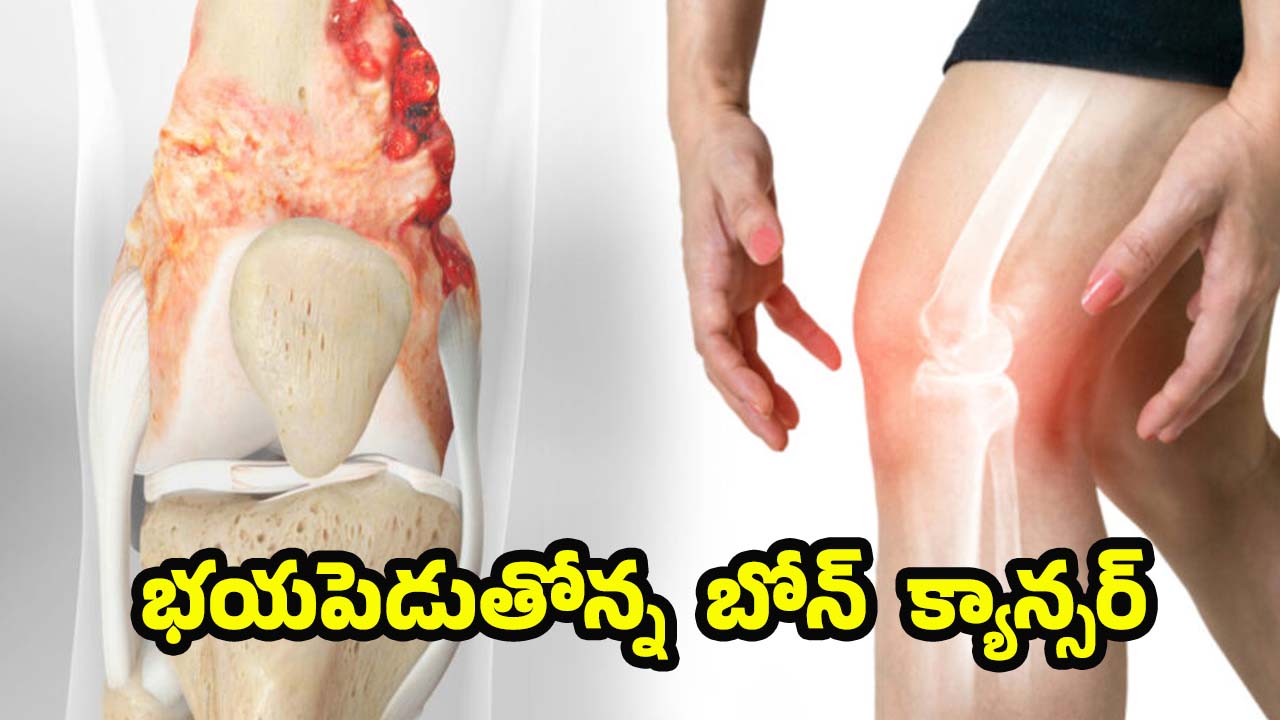 Bone Cancer Symptoms: బోన్ క్యాన్సర్.. ప్రారంభంలో కనిపించే లక్షణాలివే !