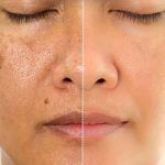 Pigmentation: ముఖంపై మంగు మచ్చలా ? ఇలా చేస్తే.. ప్రాబ్లమ్ సాల్వ్