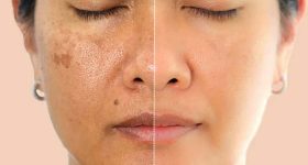 Pigmentation: ముఖంపై మంగు మచ్చలా ? ఇలా చేస్తే.. ప్రాబ్లమ్ సాల్వ్
