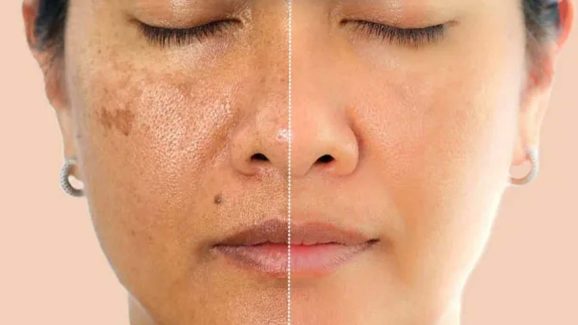 Pigmentation: ముఖంపై మంగు మచ్చలా ? ఇలా చేస్తే.. ప్రాబ్లమ్ సాల్వ్