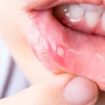 Mouth Ulcers: ఈ టిప్స్ పాటిస్తే.. నోటి పూతకు గుడ్ బై