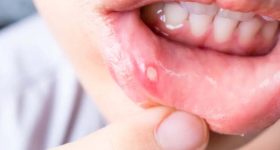 Mouth Ulcers: ఈ టిప్స్ పాటిస్తే.. నోటి పూతకు గుడ్ బై