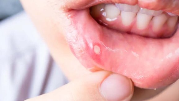 Mouth Ulcers: ఈ టిప్స్ పాటిస్తే.. నోటి పూతకు గుడ్ బై