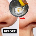 Blackheads On Nose: ముక్కుపై బ్లాక్ హెడ్స్ తగ్గాలంటే ? ఈ టిప్స్ ట్రై చేయండి