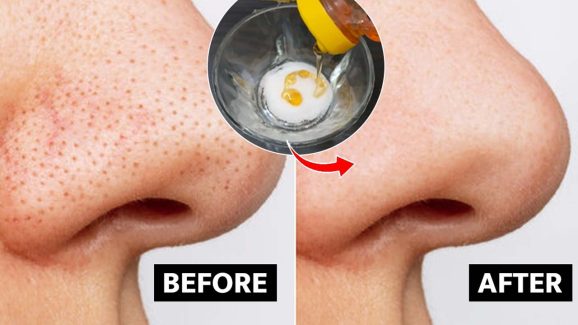 Blackheads On Nose: ముక్కుపై బ్లాక్ హెడ్స్ తగ్గాలంటే ? ఈ టిప్స్ ట్రై చేయండి