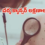 Skin cancer: మీలో ఈ లక్షణాలుంటే అస్సలు నిర్లక్ష్యం చేయకండి, స్కిన్ క్యాన్సర్ కావొచ్చు !
