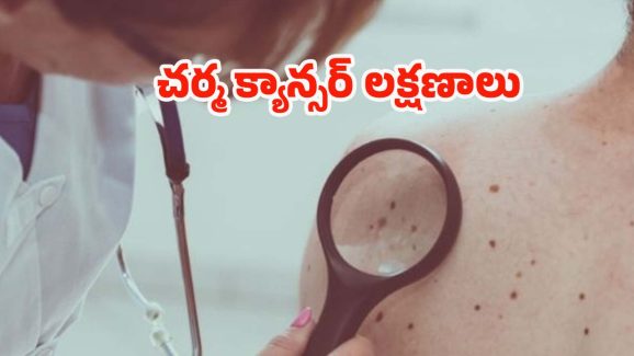 Skin cancer: మీలో ఈ లక్షణాలుంటే అస్సలు నిర్లక్ష్యం చేయకండి, స్కిన్ క్యాన్సర్ కావొచ్చు !