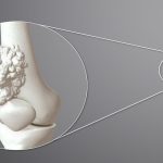 Bone Cancer: ఇవన్నీ ఎముక క్యాన్సర్ లక్షణాలే.. కానీ 95 శాతం మంది వీటిని పట్టించుకోరు