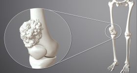 Bone Cancer: ఇవన్నీ ఎముక క్యాన్సర్ లక్షణాలే.. కానీ 95 శాతం మంది వీటిని పట్టించుకోరు