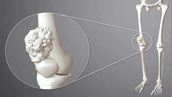 Bone Cancer: ఇవన్నీ ఎముక క్యాన్సర్ లక్షణాలే.. కానీ 95 శాతం మంది వీటిని పట్టించుకోరు