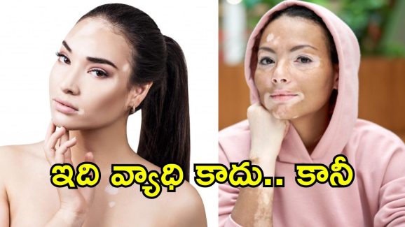 Vitiligo Day 2025: బొల్లి అంటే ఏంటి?.. ఈ చర్మ వ్యాధికి కారణాలు, అపోహలు