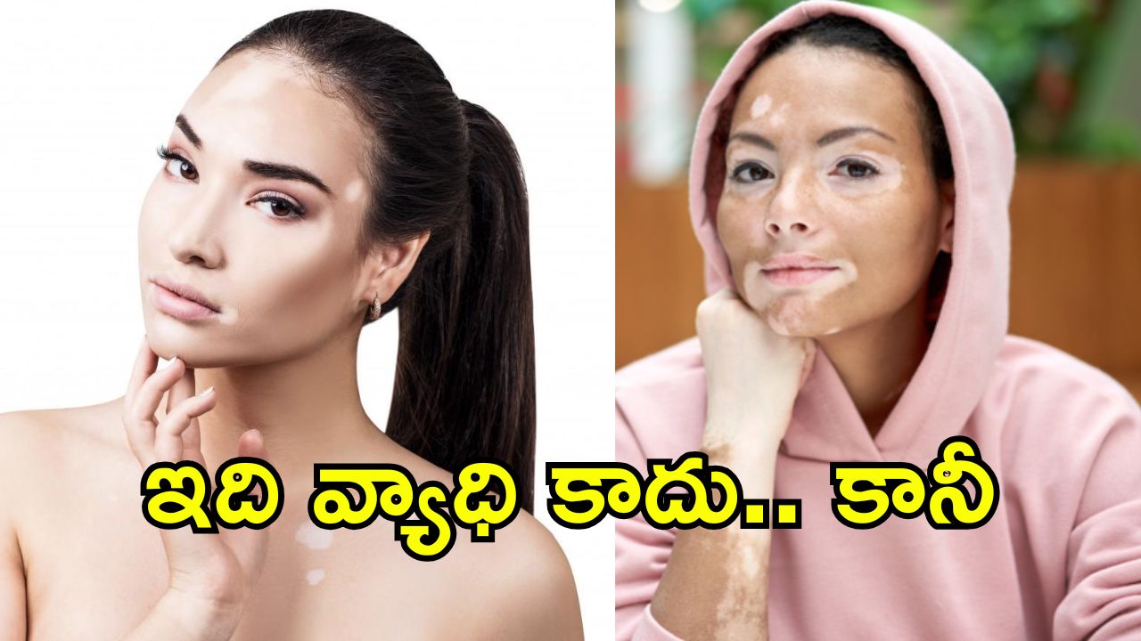 Vitiligo Day 2025: బొల్లి అంటే ఏంటి?.. ఈ చర్మ వ్యాధికి కారణాలు, అపోహలు