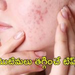 Pimples: ఈ టిప్స్ పాటిస్తే.. మొటిమలు మాయం