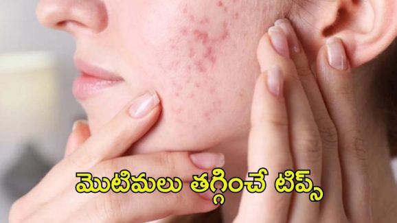 Pimples: ఈ టిప్స్ పాటిస్తే.. మొటిమలు మాయం