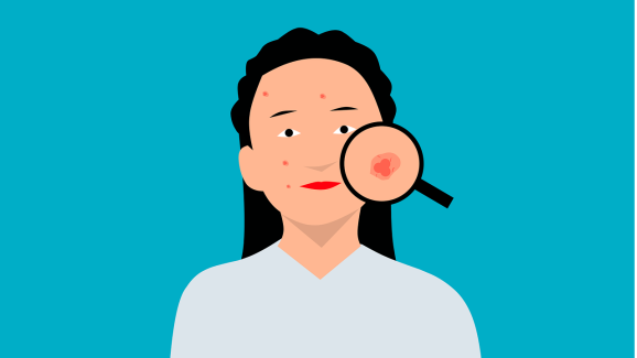 Acne: మొటిమలు, వాటి వల్ల వచ్చే గుంతలను తగ్గించే సాలిసిలిక్ యాసిడ్, దీన్ని ఎలా అప్లై చేయాలంటే